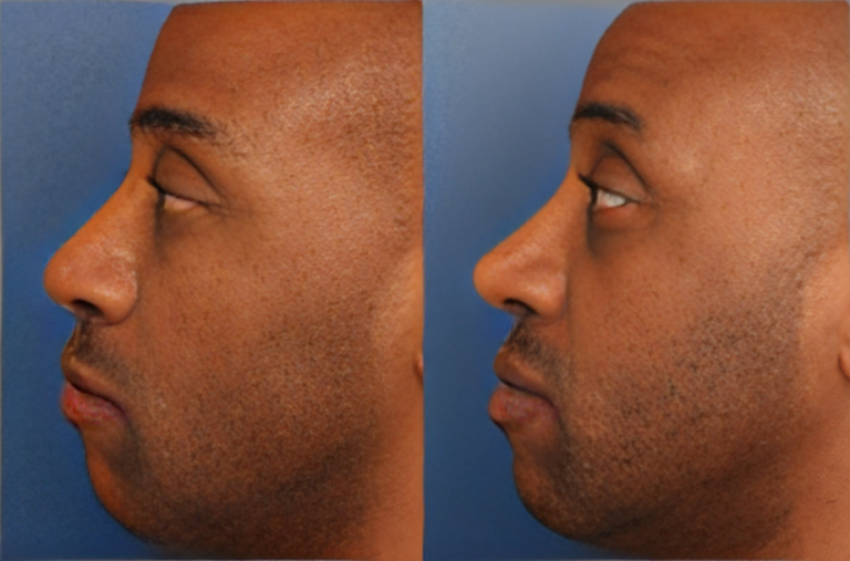 Reshaping Beauty The Art and Science of Rhinoplasty.